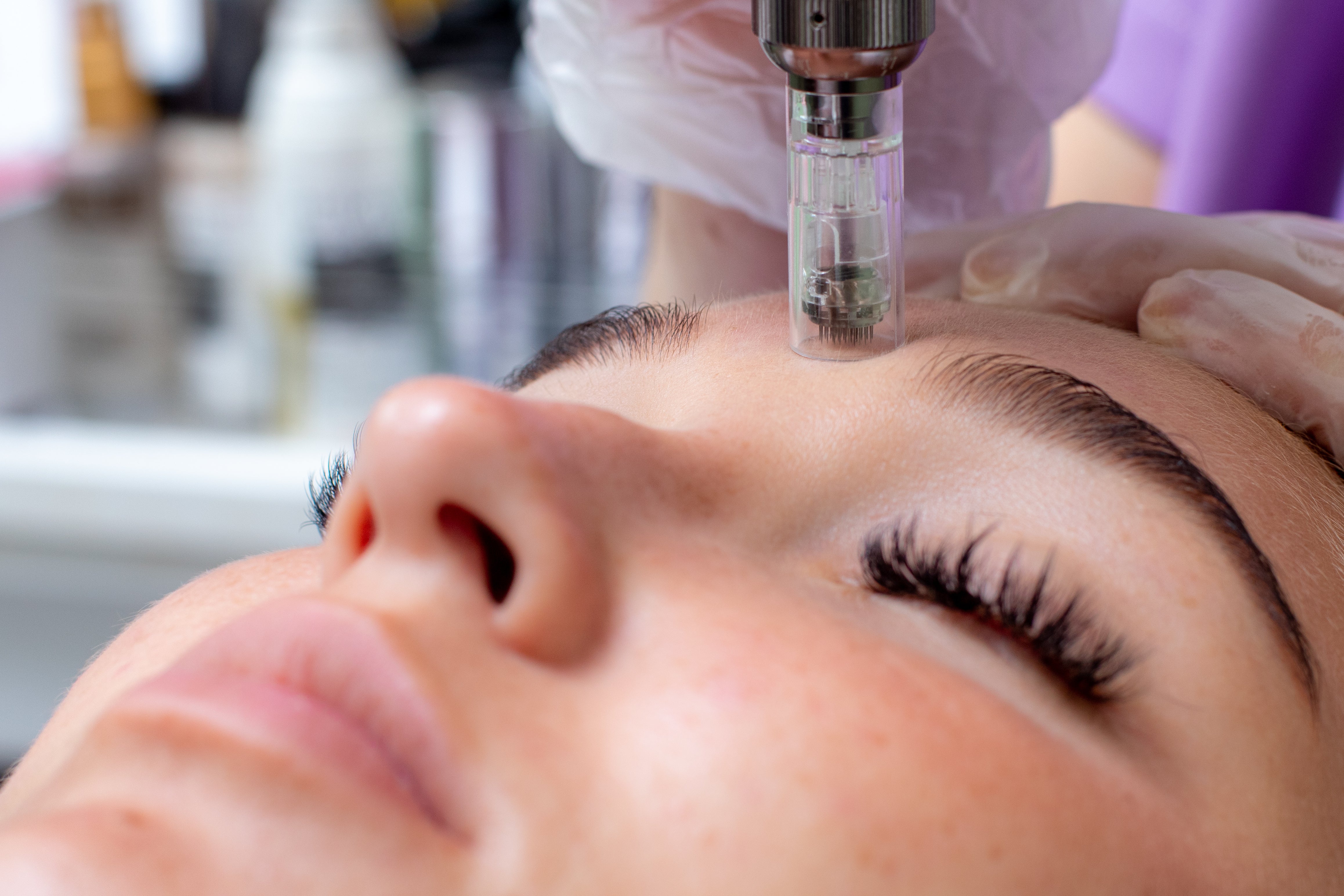 What Is Microneedling and Is It Right for You?