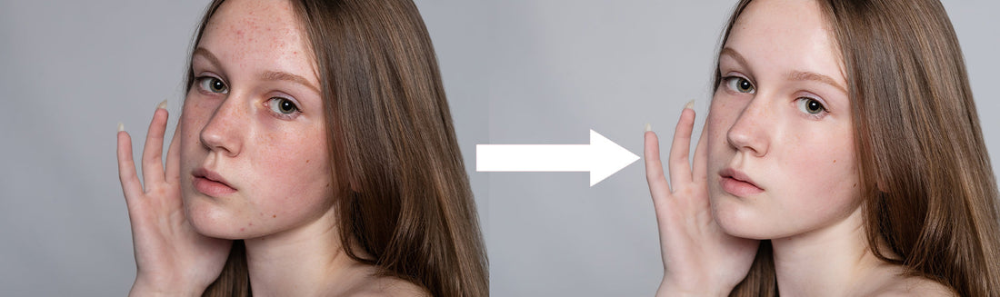 Before and after comparison showing successful acne and skin redness treatment.