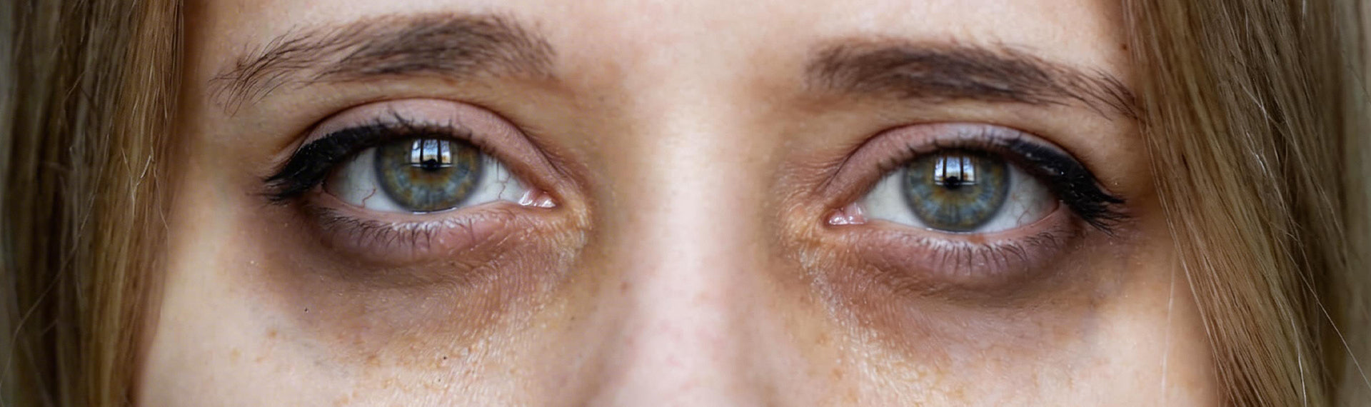 Close-up of dark circles and under-eye bags on a woman's face.