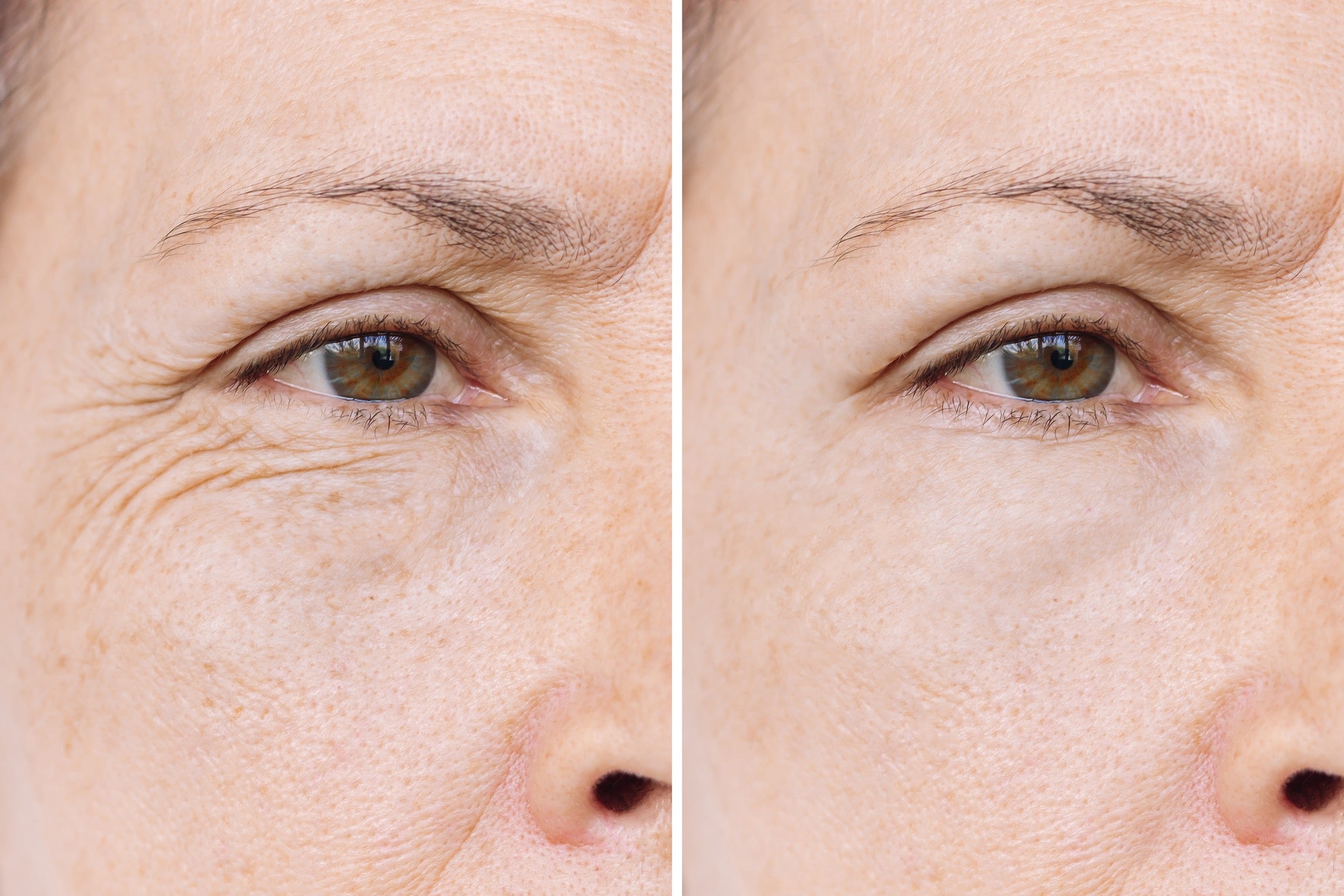 Anti-Wrinkle Injections